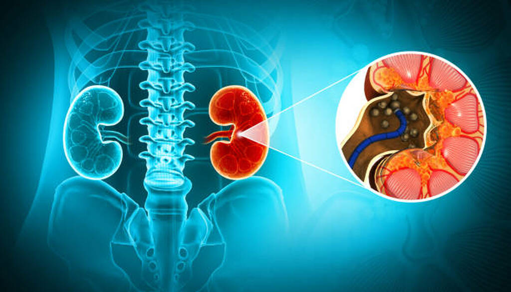 Best Kidney Stone Doctor in South Mumbai